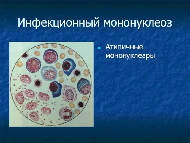 Инфекционный мононуклеоз Атипичные мононуклеары