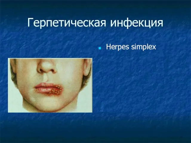 Герпетическая инфекция Herpes simplex