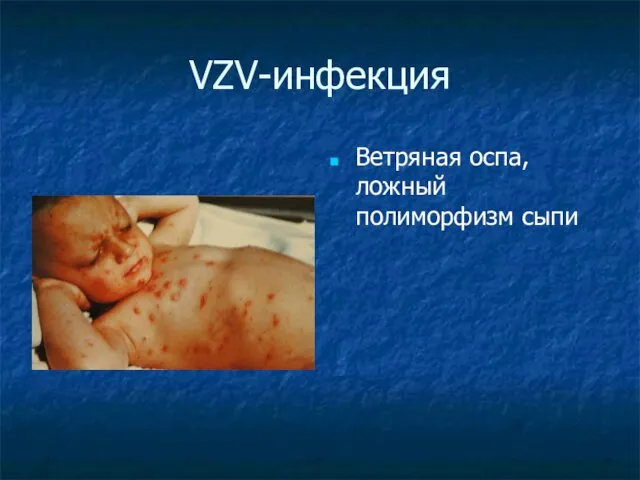 VZV-инфекция Ветряная оспа, ложный полиморфизм сыпи