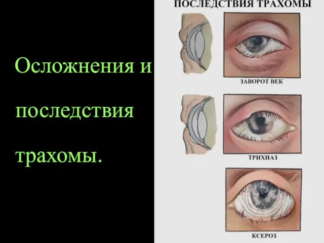 Осложнения и последствия трахомы.