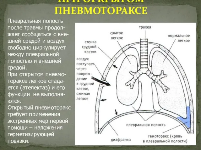 ПРИ ОТКРЫТОМ ПНЕВМОТОРАКСЕ Плевральная полость после травмы продол-жает сообщаться с вне-шней