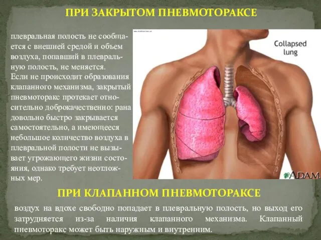 ПРИ ЗАКРЫТОМ ПНЕВМОТОРАКСЕ плевральная полость не сообща-ется с внешней средой и