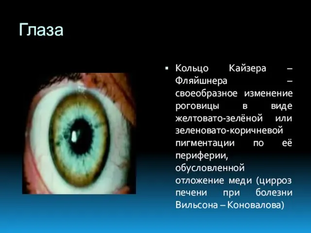 Глаза Кольцо Кайзера – Фляйшнера – своеобразное изменение роговицы в виде