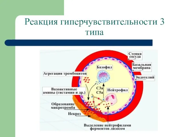 Реакция гиперчувствительности 3 типа