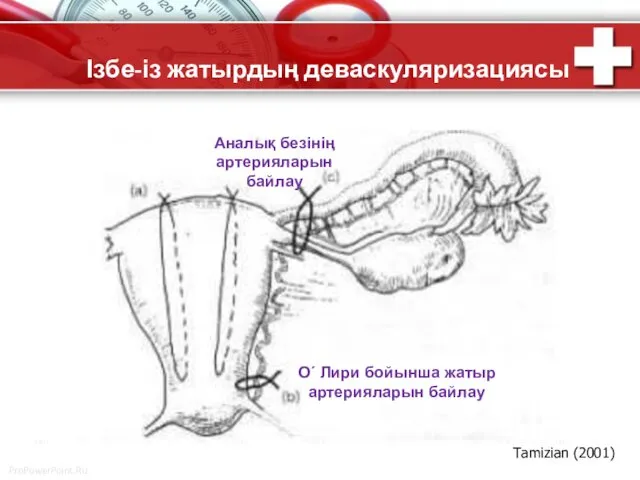 Ізбе-із жатырдың деваскуляризациясы Tamizian (2001) О´ Лири бойынша жатыр артерияларын байлау Аналық безінің артерияларын байлау