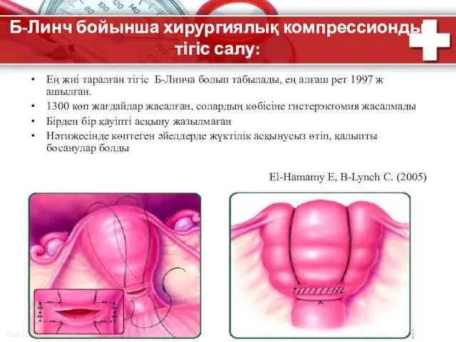 Б-Линч бойынша хирургиялық компрессионды тігіс салу: Ең жиі таралған тігіс Б-Линча