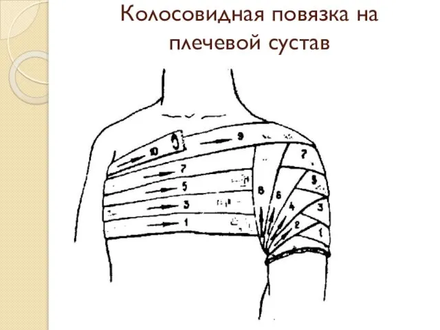 Колосовидная повязка на плечевой сустав