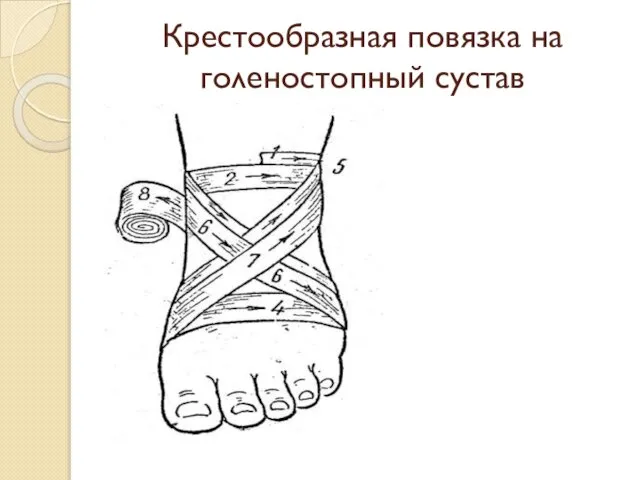 Крестообразная повязка на голеностопный сустав