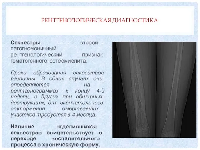 РЕНТГЕНОЛОГИЧЕСКАЯ ДИАГНОСТИКА Секвестры - второй патогномоничный рентгенологический признак гематогенного остеомиелита. Сроки