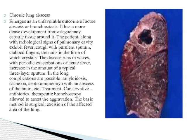 Chronic lung abscess Emerges as an unfavorable outcome of acute abscess