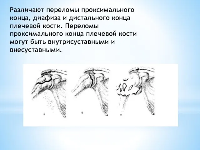 Различают переломы проксимального конца, диафиза и дистального конца плечевой кости. Переломы