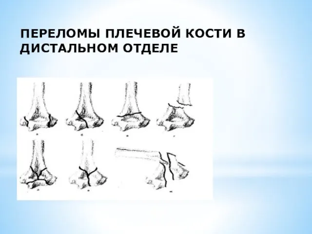 ПЕРЕЛОМЫ ПЛЕЧЕВОЙ КОСТИ В ДИСТАЛЬНОМ ОТДЕЛЕ