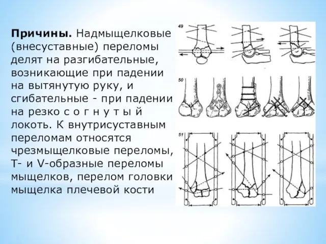 Причины. Надмыщелковые (внесуставные) переломы делят на разгибательные, возникающие при падении на