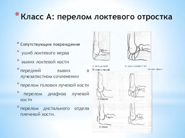 Класс А: перелом локтевого отростка Сопутствующие повреждения ушиб локтевого нерва вывих