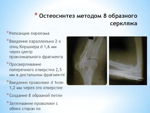 Остеосинтез методом 8 образного серкляжа Репозиция перелома Введение параллельно 2-х спиц