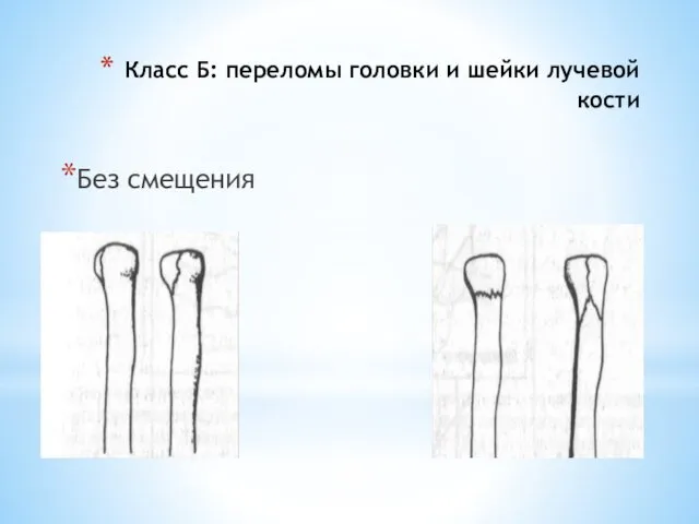 Класс Б: переломы головки и шейки лучевой кости Без смещения