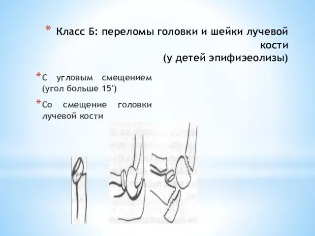 Класс Б: переломы головки и шейки лучевой кости (у детей эпифиэеолизы)