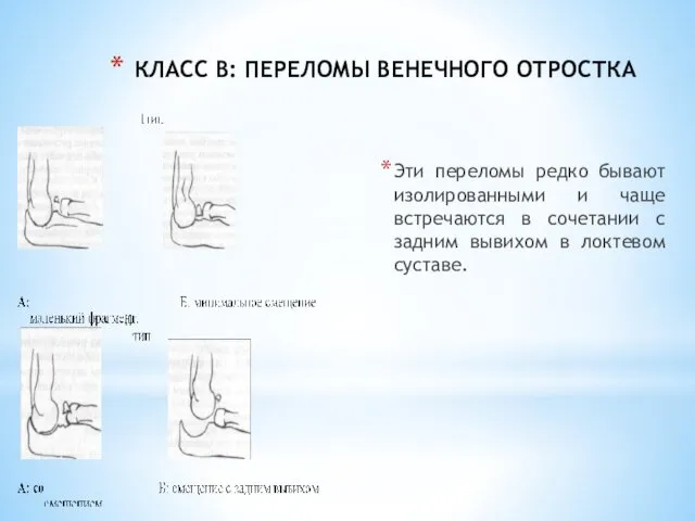 КЛАСС В: ПЕРЕЛОМЫ ВЕНЕЧНОГО ОТРОСТКА Эти переломы редко бывают изолированными и