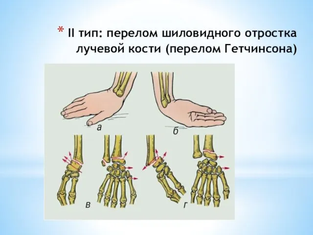 II тип: перелом шиловидного отростка лучевой кости (перелом Гетчинсона)