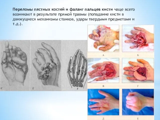 Переломы пястных костей и фаланг пальцев кисти чаще всего возникают в