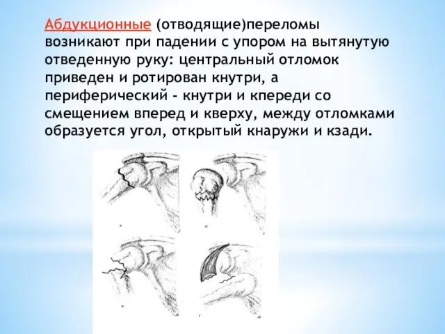 Абдукционные (отводящие)переломы возникают при падении с упором на вытянутую отведенную руку: