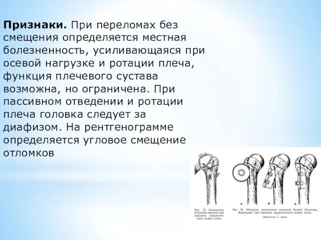 Признаки. При переломах без смещения определяется местная болезненность, усиливающаяся при осевой