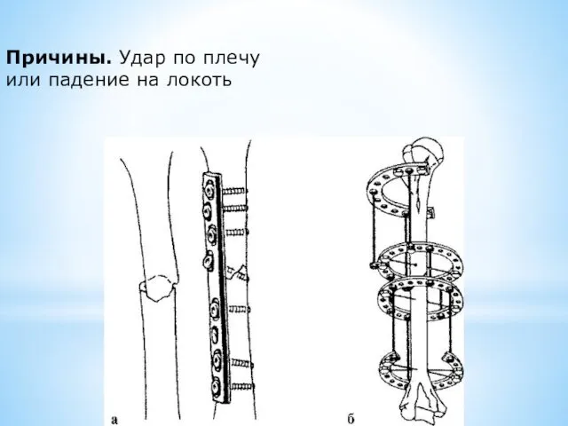 Причины. Удар по плечу или падение на локоть