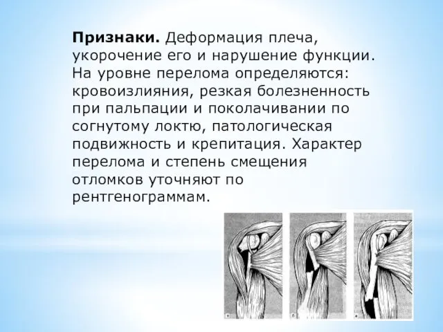 Признаки. Деформация плеча, укорочение его и нарушение функции. На уровне перелома