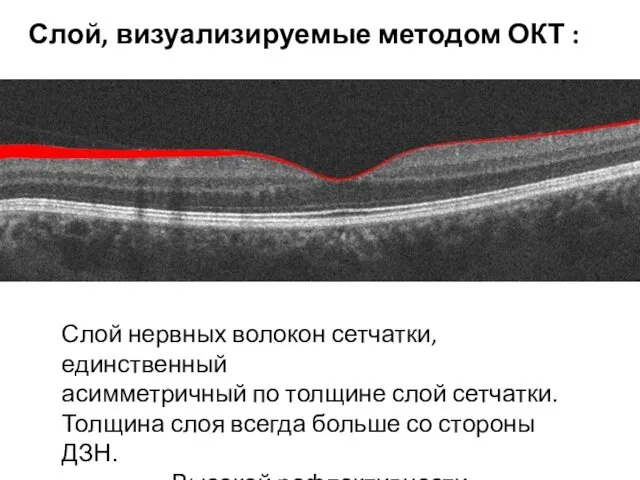 Слой нервных волокон сетчатки, единственный асимметричный по толщине слой сетчатки. Толщина