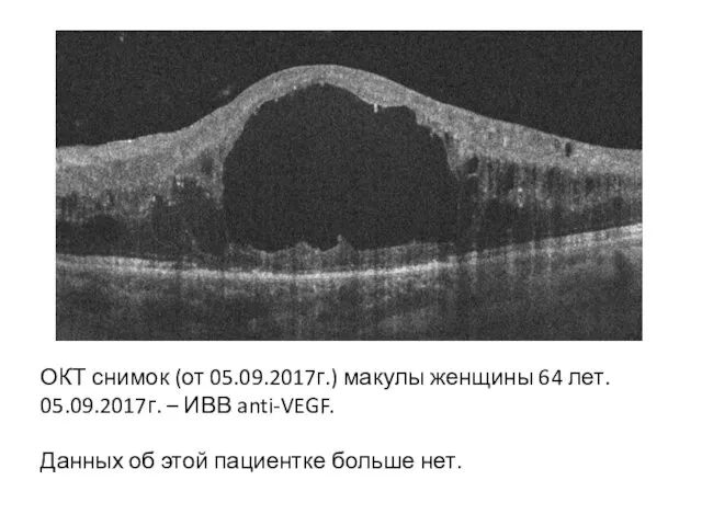 ОКТ снимок (от 05.09.2017г.) макулы женщины 64 лет. 05.09.2017г. – ИВВ