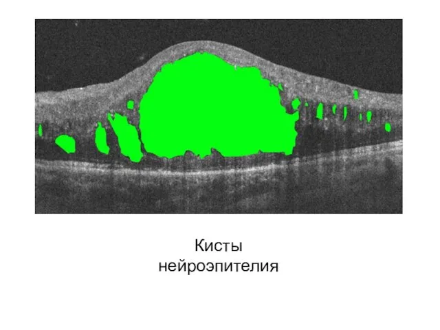 Кисты нейроэпителия