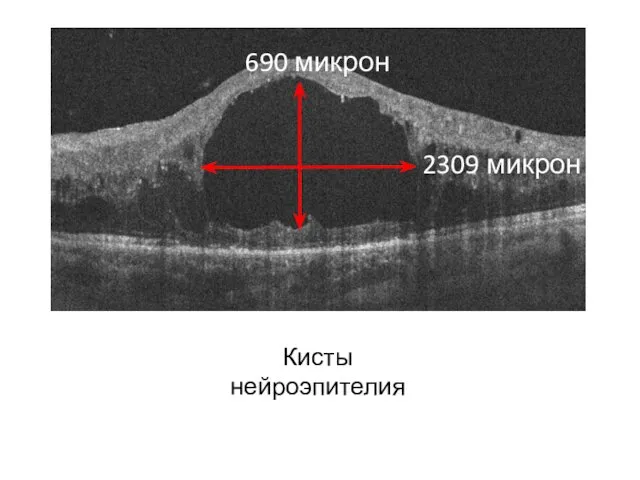 Кисты нейроэпителия 690 микрон 2309 микрон