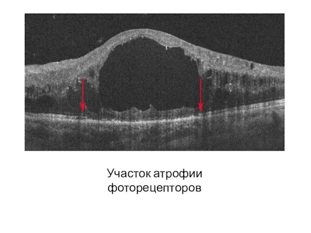 Участок атрофии фоторецепторов