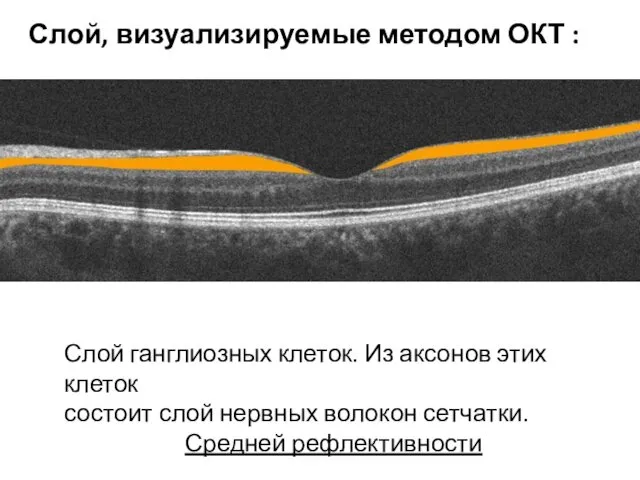 Слой ганглиозных клеток. Из аксонов этих клеток состоит слой нервных волокон