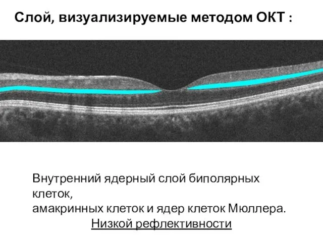 Внутренний ядерный слой биполярных клеток, амакринных клеток и ядер клеток Мюллера.