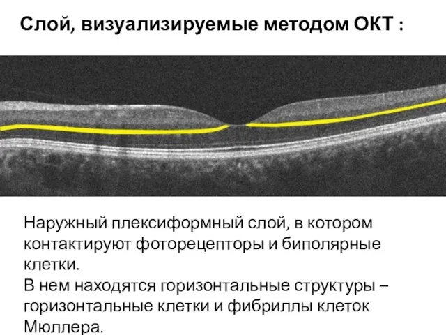 Наружный плексиформный слой, в котором контактируют фоторецепторы и биполярные клетки. В