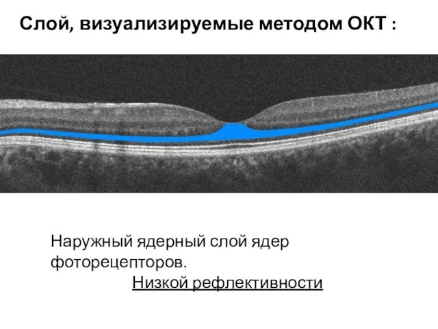 Наружный ядерный слой ядер фоторецепторов. Низкой рефлективности Слой, визуализируемые методом ОКТ :