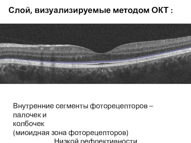 Внутренние сегменты фоторецепторов – палочек и колбочек (миоидная зона фоторецепторов) Низкой