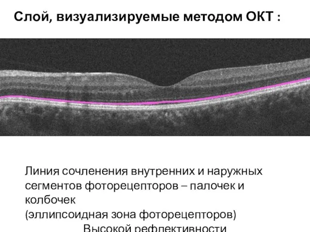 Линия сочленения внутренних и наружных сегментов фоторецепторов – палочек и колбочек