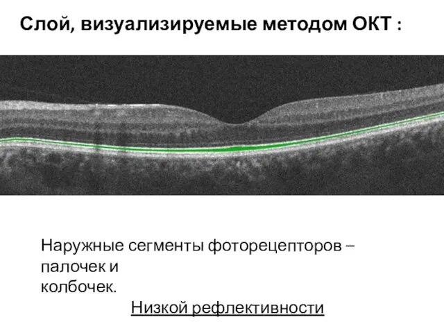 Наружные сегменты фоторецепторов – палочек и колбочек. Низкой рефлективности Слой, визуализируемые методом ОКТ :