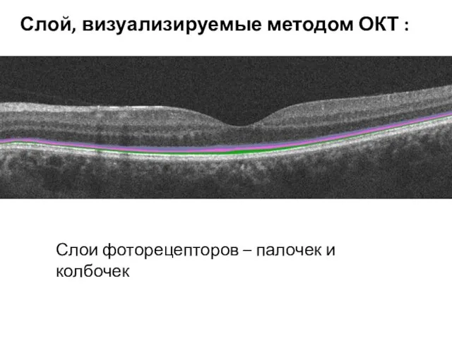 Слои фоторецепторов – палочек и колбочек Слой, визуализируемые методом ОКТ :