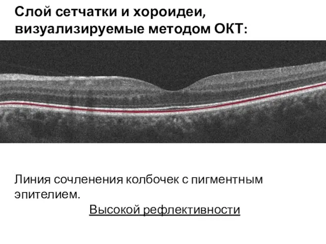 Слой сетчатки и хороидеи, визуализируемые методом ОКТ: Линия сочленения колбочек с пигментным эпителием. Высокой рефлективности