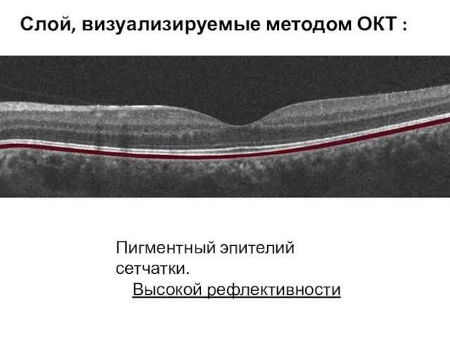 Пигментный эпителий сетчатки. Высокой рефлективности Слой, визуализируемые методом ОКТ :