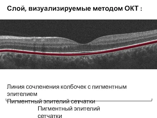 Линия сочленения колбочек с пигментным эпителием Пигментный эпителий сетчатки Пигментный эпителий