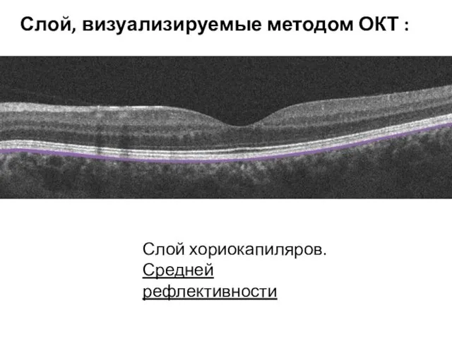 Слой хориокапиляров. Средней рефлективности Слой, визуализируемые методом ОКТ :