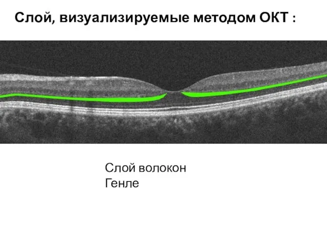 Слой волокон Генле Слой, визуализируемые методом ОКТ :