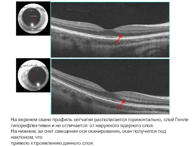 На верхнем скане профиль сетчатки располагается горизонтально, слой Генле гипорефлективен и