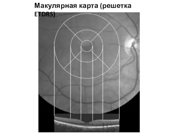 Макулярная карта (решетка ETDRS)