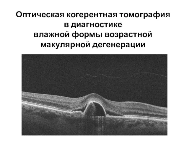 Оптическая когерентная томография в диагностике влажной формы возрастной макулярной дегенерации