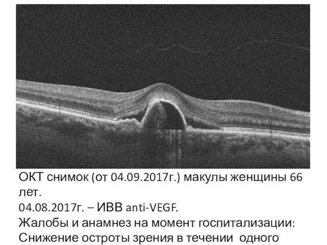 ОКТ снимок (от 04.09.2017г.) макулы женщины 66 лет. 04.08.2017г. – ИВВ